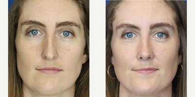 Case: 3208 - before and after photo of Woman treated with Rhinoplasty by Ali Sajjadian, MD, FACS