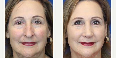 Case: 3209 - before and after photo of Woman treated with Rhinoplasty by Ali Sajjadian, MD, FACS