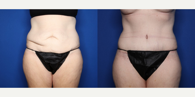 Case 321 - 35-44 year old woman treated with Tummy Tuck