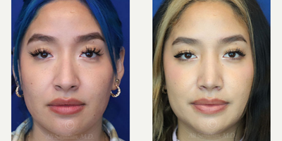 Case 3210 - Woman treated with Rhinoplasty