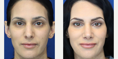 Case 3211 - Woman treated with Rhinoplasty