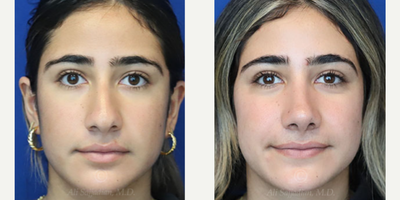Case 3212 - Woman treated with Rhinoplasty