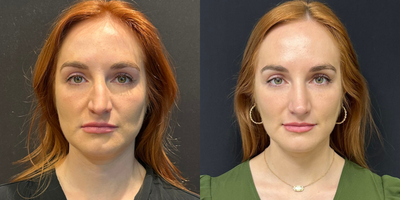 Case 3214 - Woman treated with Rhinoplasty