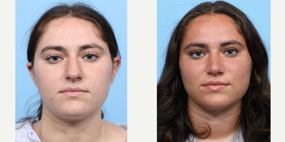 Case 3215 - 18-24 year old woman treated with Rhinoplasty