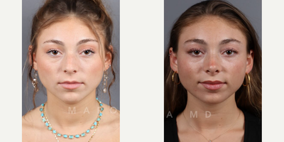 Case 3216 - Woman treated with Rhinoplasty, Septoplasty