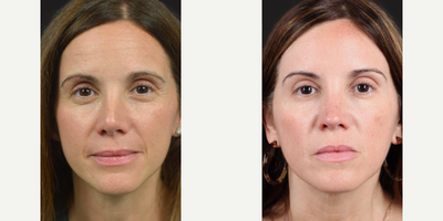 Case 3219 - Woman treated with Rhinoplasty