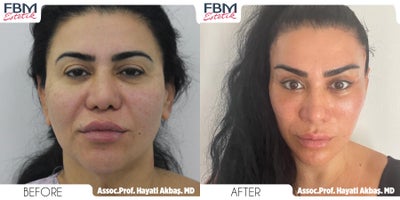 Case 3220 - 45-54 year old woman treated with Deep Plane Facelift, Neck Lift, Rhinoplasty, Lip Lift, Canthoplasty, Eyelid Surgery, Facial Fa