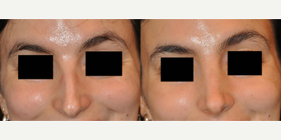 Case 3221 - Woman treated with Rhinoplasty