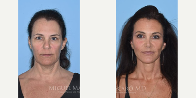 Case 3222 - Woman treated with Rhinoplasty