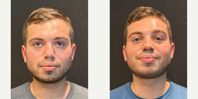 Case 3224 - Man treated with Rhinoplasty