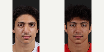 Case 3225 - Man treated with Rhinoplasty