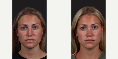 Case 3226 - Woman treated with Rhinoplasty, Septoplasty