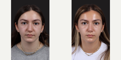 Case 3227 - Woman treated with Rhinoplasty, Septoplasty