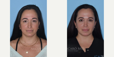 Case 3228 - Woman treated with Rhinoplasty