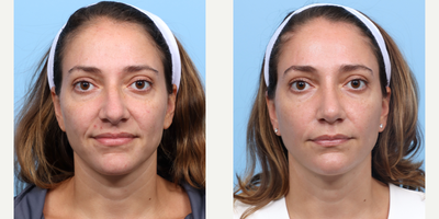 Case 3229 - 35-44 year old woman treated with Rhinoplasty