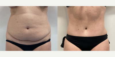 Case 323 - 35-44 year old woman treated with Tummy Tuck