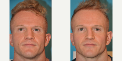 Case 3230 - Man treated with Rhinoplasty