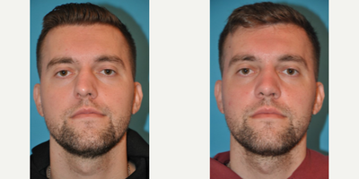 Case 3231 - Man treated with Rhinoplasty