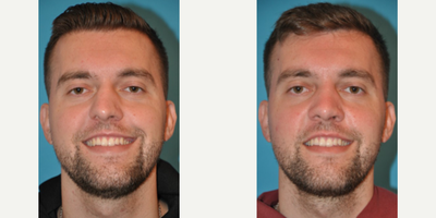 Case 3232 - Man treated with Rhinoplasty