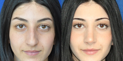 Case 3233 - Woman treated with Rhinoplasty