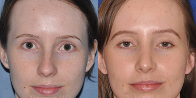 Case 3234 - Woman treated with Rhinoplasty