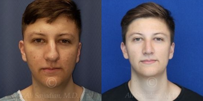 Case 3235 - Man treated with Rhinoplasty