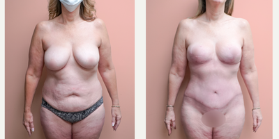 Case 324 - 45-54 year old woman treated with Tummy Tuck