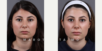 Case 3240 - Woman treated with Rhinoplasty