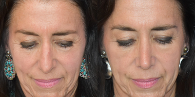 Case 3241 - Woman treated with Rhinoplasty