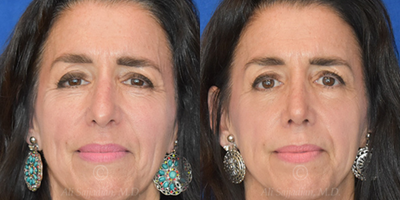 Case 3242 - Woman treated with Rhinoplasty