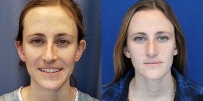 Case 3244 - Woman treated with Rhinoplasty