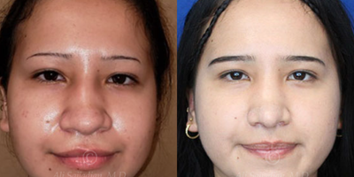 Case 3248 - Woman treated with Rhinoplasty