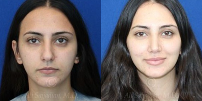 Case 3249 - Woman treated with Rhinoplasty