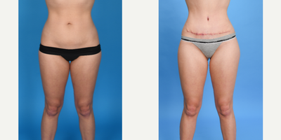 Case 325 - 25 year old woman treated with Tummy Tuck