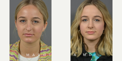 Case 3250 - Woman treated with Rhinoplasty