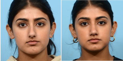 Case 3252 - 25-34 year old woman treated with Rhinoplasty