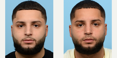 Case 3253 - 18-24 year old man treated with Rhinoplasty