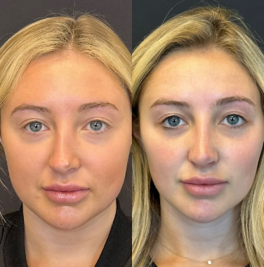 Case 3254 - Woman treated with Rhinoplasty