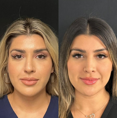 Case 3255 - Woman treated with Rhinoplasty
