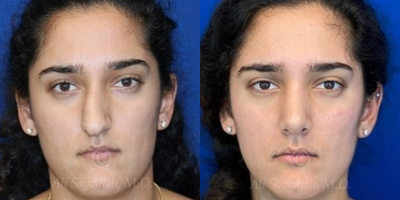 Case 3256 - Woman treated with Rhinoplasty