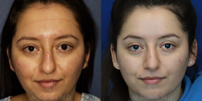 Case 3257 - Woman treated with Rhinoplasty