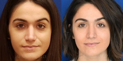 Case 3258 - Woman treated with Rhinoplasty