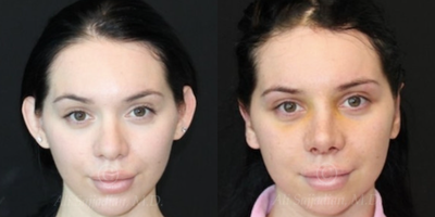 Case 3259 - Woman treated with Rhinoplasty