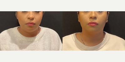 Case 3260 - Woman treated with Rhinoplasty