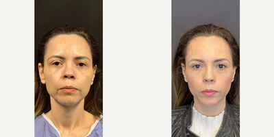 Case 3261 - Woman treated with Rhinoplasty