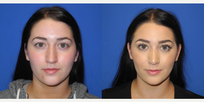 Case 3262 - Woman treated with Rhinoplasty