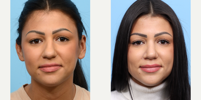 Case 3263 - 25-34 year old woman treated with Rhinoplasty