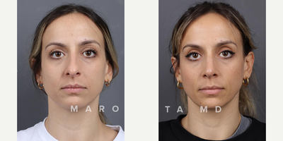 Case 3266 - Woman treated with Rhinoplasty