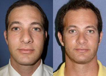 Case 3267 - Man treated with Rhinoplasty