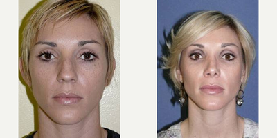 Case 3268 - Woman treated with Rhinoplasty